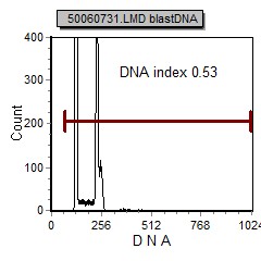 Acute B Lymphoblastic Leukemia (B-ALL) | Flow Cytometry